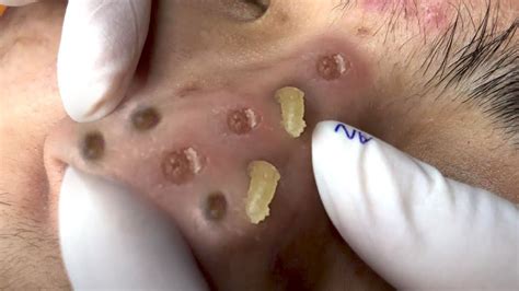 nasty blackheads 2023|giant deep blackheads removed 2023.